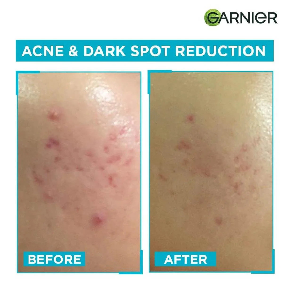 Garnier Anti-Acne Serum (30ml) Glamour Glow 